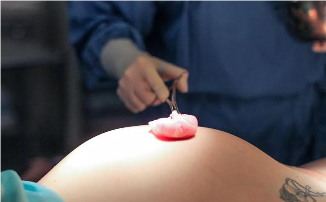 孕妇剖腹产麻醉针怎样打的 剖腹产麻醉的后遗症有哪些
