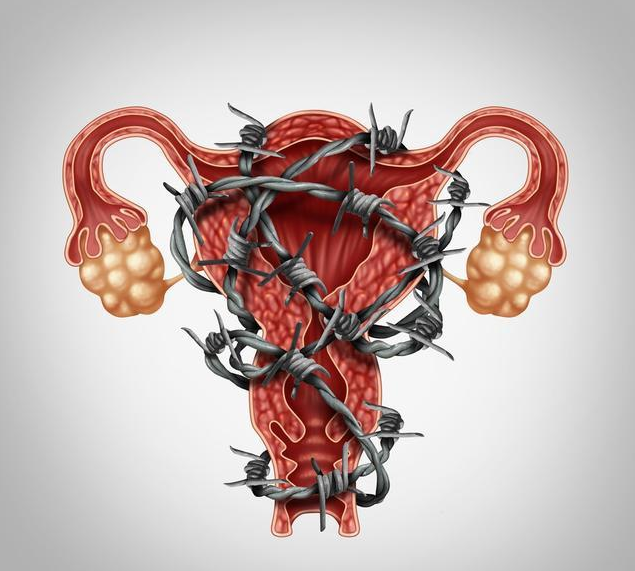 子宫内膜异位症会影响不孕吗 子宫内膜异位症护理方法