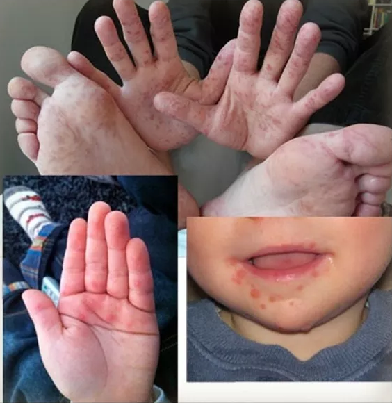小儿手足口病严重吗 小儿手足口病会引起哪些并发症