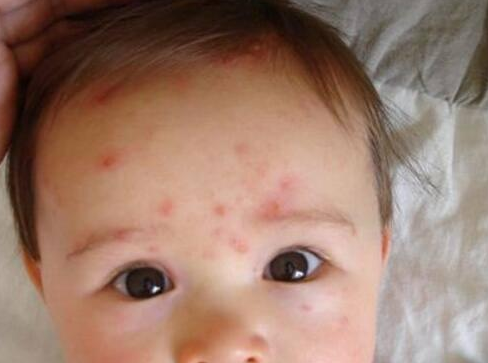宝宝第一次发高烧是幼儿急疹吗 宝宝幼儿急疹怎么护理