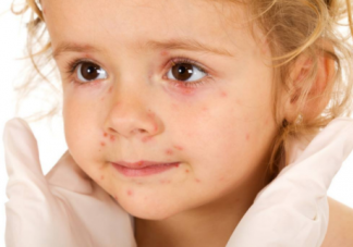 造成孩子过敏体质的原因 过敏体质是什么原因造成的