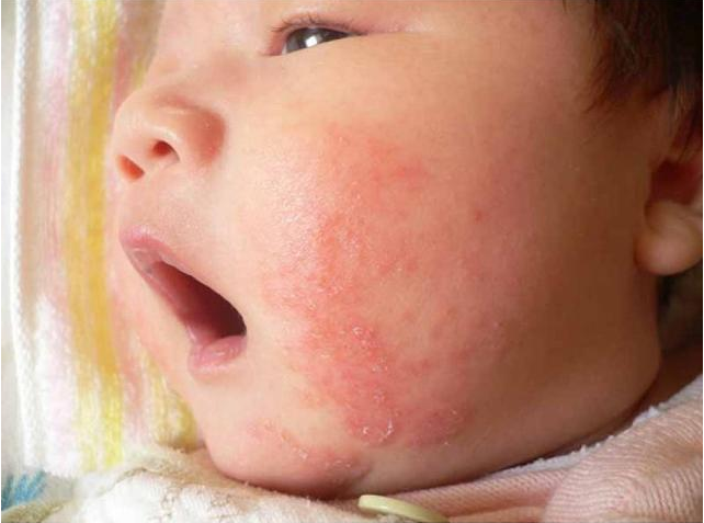 宝宝湿疹反复不好是怎么回事 宝宝湿疹反复不好的原因