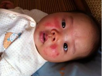 宝宝湿疹反复不好是怎么回事 宝宝湿疹反复不好的原因