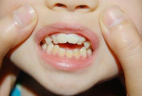 儿童牙齿不整齐怎么办 儿童牙齿不整齐的原因