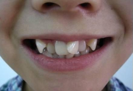 儿童牙齿不整齐怎么办 儿童牙齿不整齐的原因