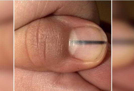 孩子指甲上有黑线是怎么回事 指甲有黑色竖线是得了癌吗