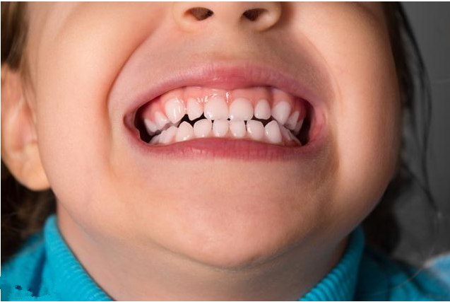 孩子门牙掉了什么时候能长出来 孩子门牙掉了急救处理方法
