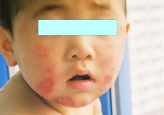 小儿湿疹能吃什么 小儿湿疹不能吃什么