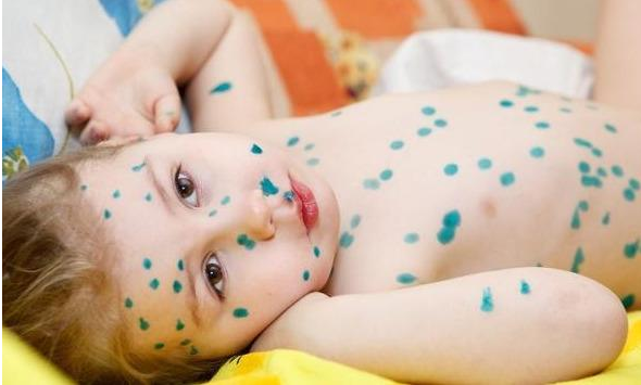 水痘潜伏期是多久 孩子得了水痘怎么护理