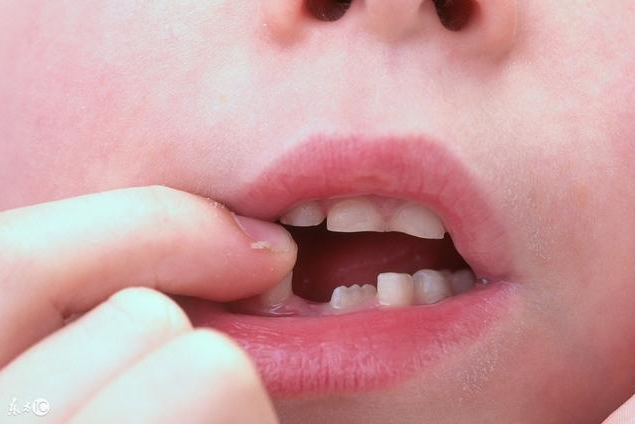 牙周疾病对怀孕有什么影响 孕妇牙龈肿痛怎么调理