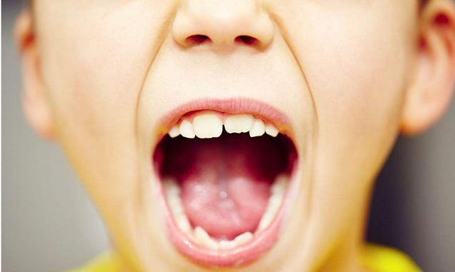 儿童矫正最佳年龄是什么时候 儿童做矫正牙齿后注意事项