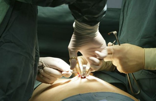 剖宫产切口怎么护理 剖宫产横切和竖切哪个好