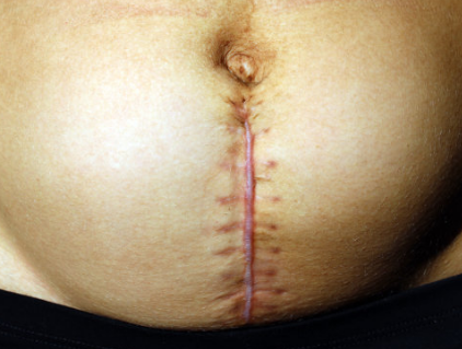 剖腹产的疤痕会对女性有什么影响 剖腹产后疤痕该如何护理
