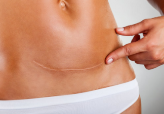 剖腹产的疤痕会对女性有什么影响 剖腹产后疤痕该如何护理