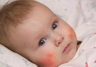 春季宝宝湿疹高峰期 宝宝湿疹护理方法