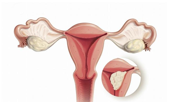 月经量多更容易得子宫内膜癌吗 子宫内膜癌的早期表现