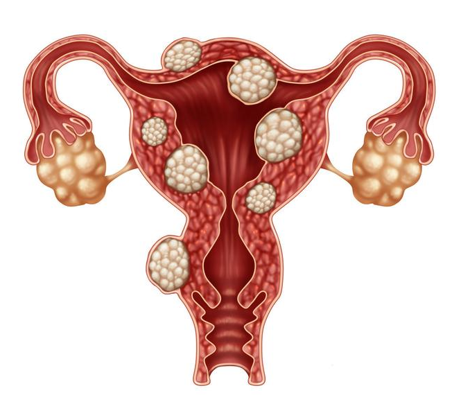 子宫肌瘤怀孕了对胎儿有没有影响 子宫肌瘤是怎么形成的