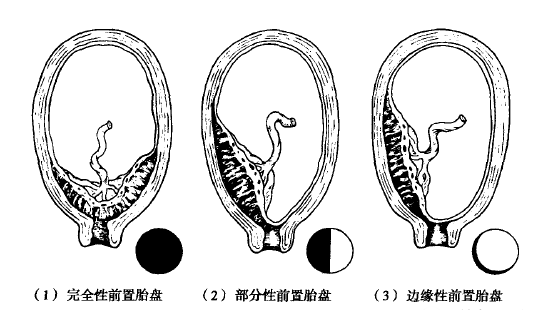 孕早期胎盘前置的原因 孕早期胎盘前置的症状
