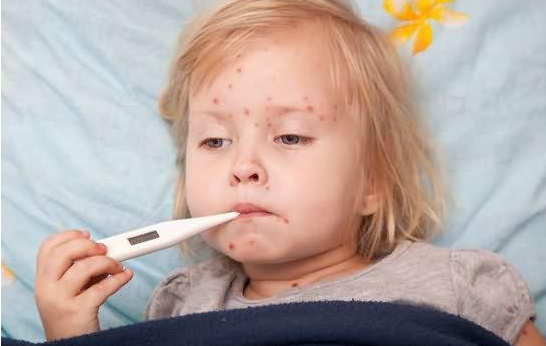 孩子得了麻疹会很危险吗 得了麻疹的潜伏期和相关症状
