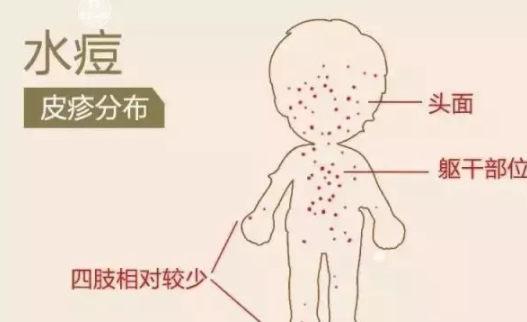 宝宝出水痘会留疤吗 出水痘祛除疤痕的方法