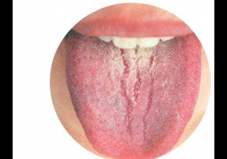 小儿草莓舌是什么  孩子草莓舌是身体有什么异常吗