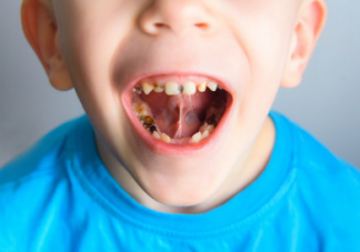 不吃糖也会引起满嘴的烂牙 孩子牙齿长不好是因为这几点习惯