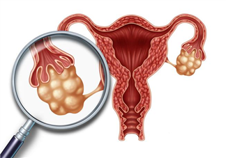多囊卵巢综合征怀孕初期要注意什么 多囊卵巢综合征怀孕注意事项