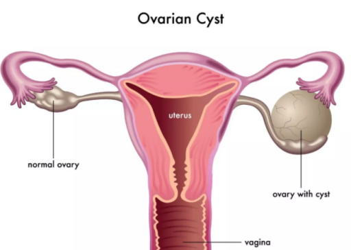 卵巢囊肿时有时无怎么回事 卵巢囊肿时有时无怎么办