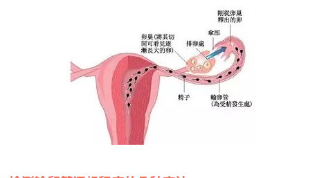 输卵管不通怎么办 输卵管不通如何助孕