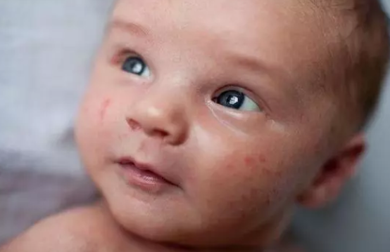 婴儿奶粉过敏怎么选择奶粉 婴儿防过敏奶粉怎么选择