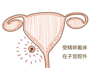 宫外孕和宫内孕感觉有什么不同 女性怀孕后多久能查出宫外孕