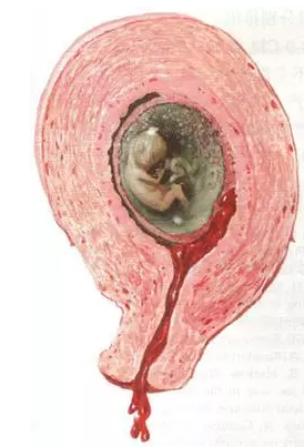 孕激素保胎要用多久 孕激素保胎的三个特征