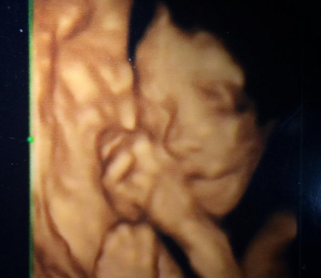四维彩超胎儿总是趴着怎么回事 做四维彩超宝宝不配合怎么办