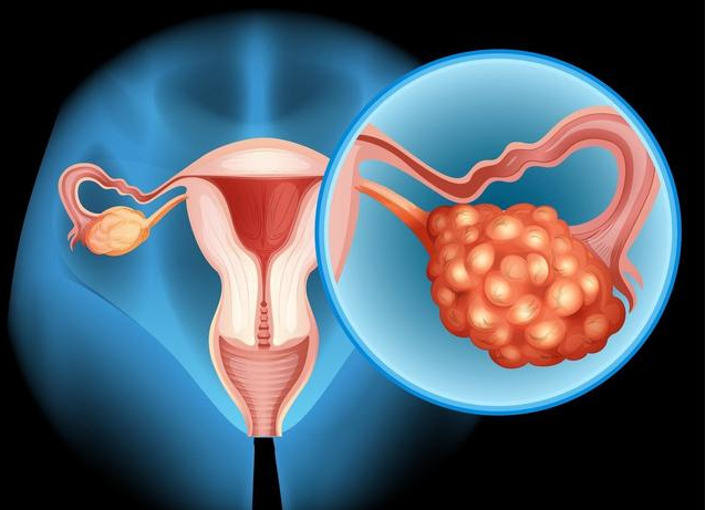 女性卵巢早衰有什么表现 卵巢早衰怎么治疗