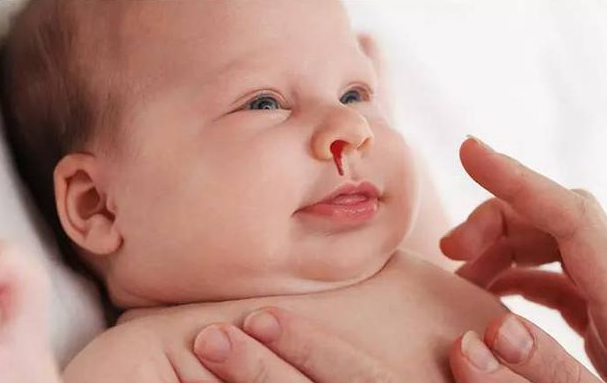 什么样的宝宝容易流鼻血 怎么预防宝宝流鼻血